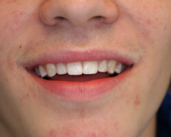 Cosmetic Bonding Before and After at Brookdale Dental Group in Bloomfeild, NJ.