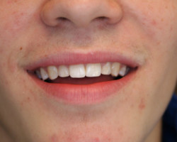 Cosmetic Bonding Before and After at Brookdale Dental Group in Bloomfeild, NJ.
