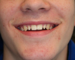 Cosmetic Bonding Before and After at Brookdale Dental Group in Bloomfeild, NJ.