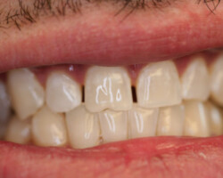 Tooth Whitening Before and After at Brookdale Dental Group in Bloomfeild, NJ.