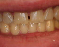 Tooth Whitening Before and After at Brookdale Dental Group in Bloomfeild, NJ.