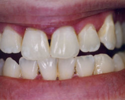 Tooth Whitening Before and After at Brookdale Dental Group in Bloomfeild, NJ.
