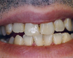 Tooth Whitening Before and After at Brookdale Dental Group in Bloomfeild, NJ.