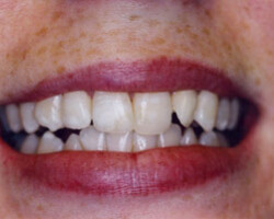 Tooth Whitening Before and After at Brookdale Dental Group in Bloomfeild, NJ.