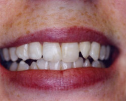 Tooth Whitening Before and After at Brookdale Dental Group in Bloomfeild, NJ.