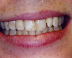 Tooth Whitening Before and After at Brookdale Dental Group in Bloomfeild, NJ.