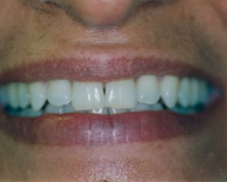 Tooth Whitening Before and After at Brookdale Dental Group in Bloomfeild, NJ.