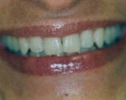 Tooth Whitening Before and After at Brookdale Dental Group in Bloomfeild, NJ.