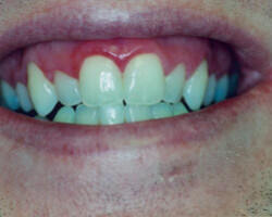 Tooth Whitening Before and After at Brookdale Dental Group in Bloomfeild, NJ.