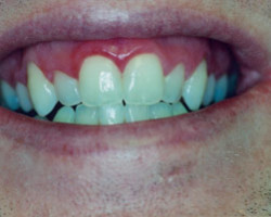 Tooth Whitening Before and After at Brookdale Dental Group in Bloomfeild, NJ.