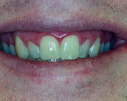 Tooth Whitening Before and After at Brookdale Dental Group in Bloomfeild, NJ.