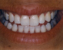 Tooth Whitening Before and After at Brookdale Dental Group in Bloomfeild, NJ.