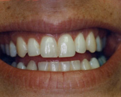 Tooth Whitening Before and After at Brookdale Dental Group in Bloomfeild, NJ.