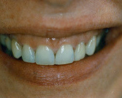 Tooth Whitening Before and After at Brookdale Dental Group in Bloomfeild, NJ.