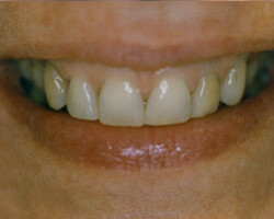 Tooth Whitening Before and After at Brookdale Dental Group in Bloomfeild, NJ.