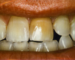 Tooth Whitening Before and After at Brookdale Dental Group in Bloomfeild, NJ.