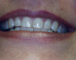 Tooth Whitening Before and After at Brookdale Dental Group in Bloomfeild, NJ.