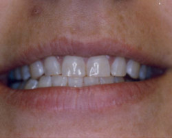 Tooth Whitening Before and After at Brookdale Dental Group in Bloomfeild, NJ.