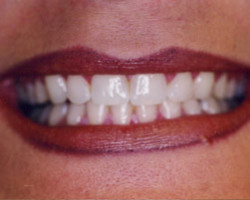 Tooth Whitening Before and After at Brookdale Dental Group in Bloomfeild, NJ.