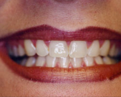 Tooth Whitening Before and After at Brookdale Dental Group in Bloomfeild, NJ.