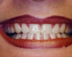 Tooth Whitening Before and After at Brookdale Dental Group in Bloomfeild, NJ.