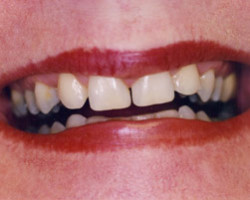 Tooth Whitening Before and After at Brookdale Dental Group in Bloomfeild, NJ.