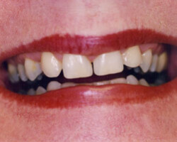 Tooth Whitening Before and After at Brookdale Dental Group in Bloomfeild, NJ.