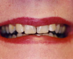 Tooth Whitening Before and After at Brookdale Dental Group in Bloomfeild, NJ.
