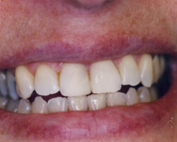 Tooth Whitening Before and After at Brookdale Dental Group in Bloomfeild, NJ.