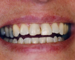 Tooth Whitening Before and After at Brookdale Dental Group in Bloomfeild, NJ.