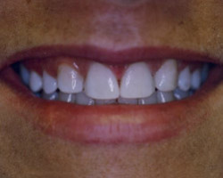 Tooth Whitening Before and After at Brookdale Dental Group in Bloomfeild, NJ.