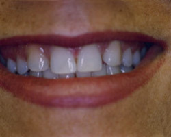 Tooth Whitening Before and After at Brookdale Dental Group in Bloomfeild, NJ.