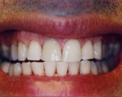 Tooth Whitening Before and After at Brookdale Dental Group in Bloomfeild, NJ.