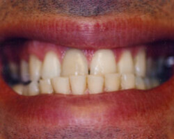 Tooth Whitening Before and After at Brookdale Dental Group in Bloomfeild, NJ.