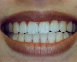 Tooth Whitening Before and After at Brookdale Dental Group in Bloomfeild, NJ.