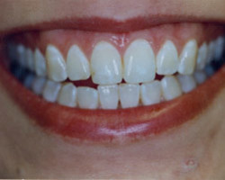 Tooth Whitening Before and After at Brookdale Dental Group in Bloomfeild, NJ.