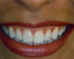 Tooth Whitening Before and After at Brookdale Dental Group in Bloomfeild, NJ.