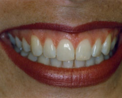Tooth Whitening Before and After at Brookdale Dental Group in Bloomfeild, NJ.