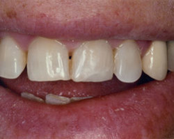 Cosmetic Bonding Before and After at Brookdale Dental Group in Bloomfeild, NJ.