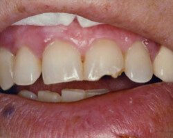 Cosmetic Bonding Before and After at Brookdale Dental Group in Bloomfeild, NJ.