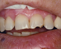 Cosmetic Bonding Before and After at Brookdale Dental Group in Bloomfeild, NJ.