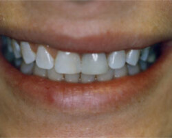 Cosmetic Bonding Before and After at Brookdale Dental Group in Bloomfeild, NJ.