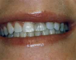 Cosmetic Bonding Before and After at Brookdale Dental Group in Bloomfeild, NJ.