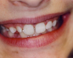 Cosmetic Bonding Before and After at Brookdale Dental Group in Bloomfeild, NJ.