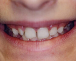 Cosmetic Bonding Before and After at Brookdale Dental Group in Bloomfeild, NJ.