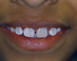 Cosmetic Bonding Before and After at Brookdale Dental Group in Bloomfeild, NJ.