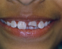 Cosmetic Bonding Before and After at Brookdale Dental Group in Bloomfeild, NJ.