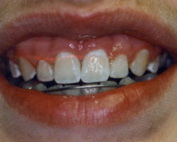 Cosmetic Bonding Before and After at Brookdale Dental Group in Bloomfeild, NJ.