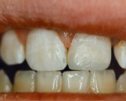 Cosmetic Bonding Before and After at Brookdale Dental Group in Bloomfeild, NJ.