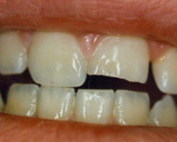 Cosmetic Bonding Before and After at Brookdale Dental Group in Bloomfeild, NJ.